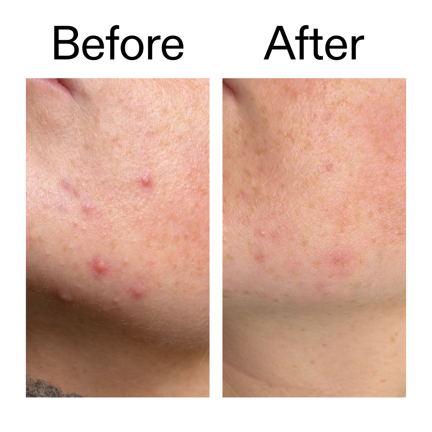 10-azelaic-acid-serum-for-redness-relief-k0 B_A_1_PPAGE.png