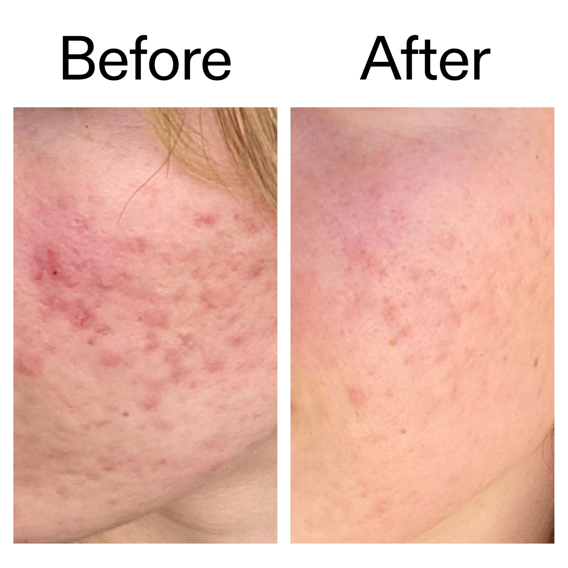 10-azelaic-acid-serum-for-redness-relief-k0 Azealic_Acid_Serum_B_A_Ppage_2000_x_2000.jpg