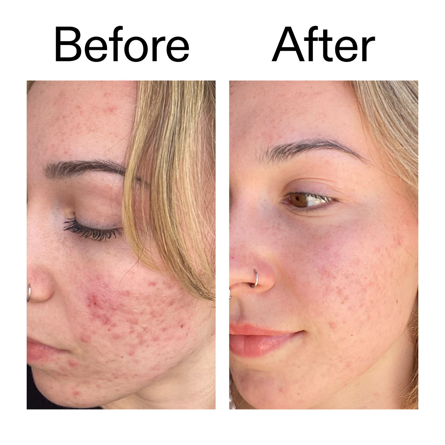 10-azelaic-acid-serum-for-redness-relief-k0 B_A_2_PPAGE.png