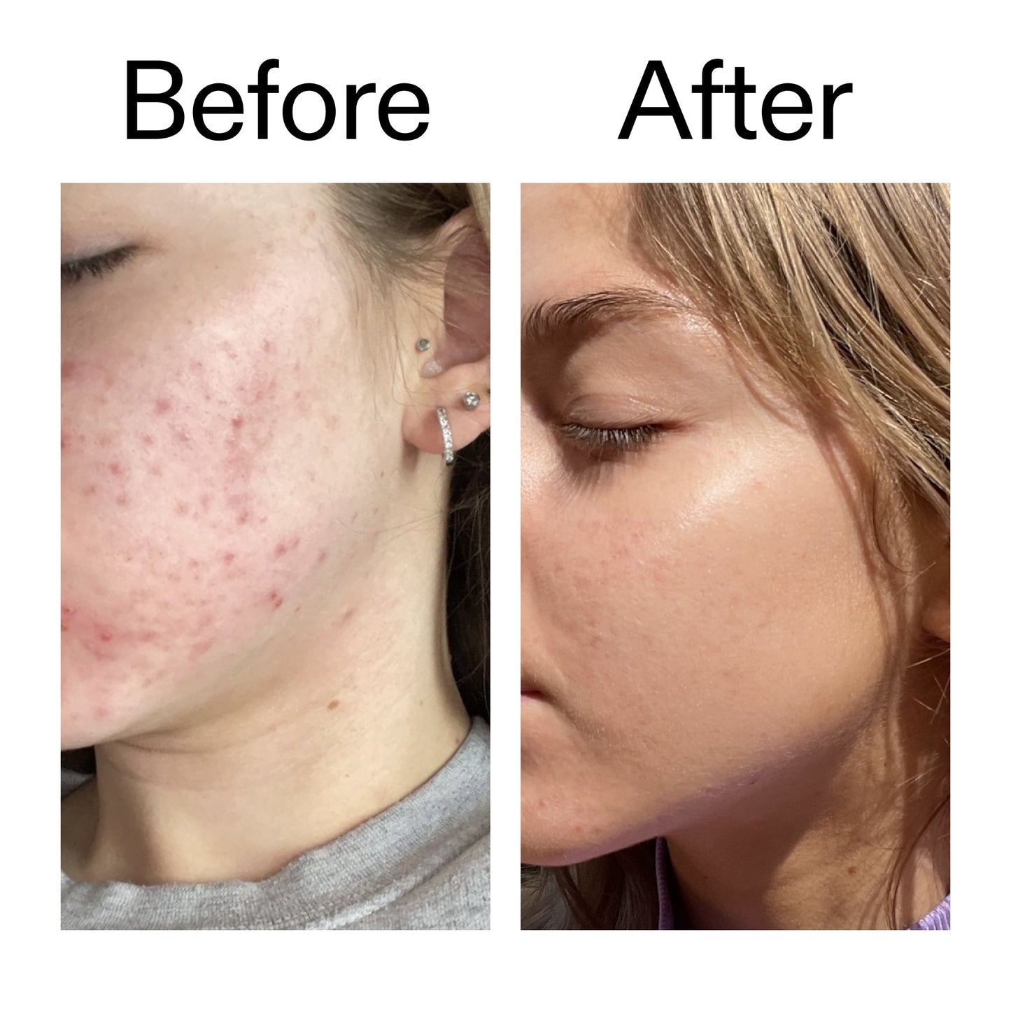 beta-hydroxy-acid-bha-serum-s5 Beta_Hydroxy_Acid_Serum_Before_After_2000x2000_96fda3e5-938d-49ef-bcf2-a0fa6ece4e2c.jpg