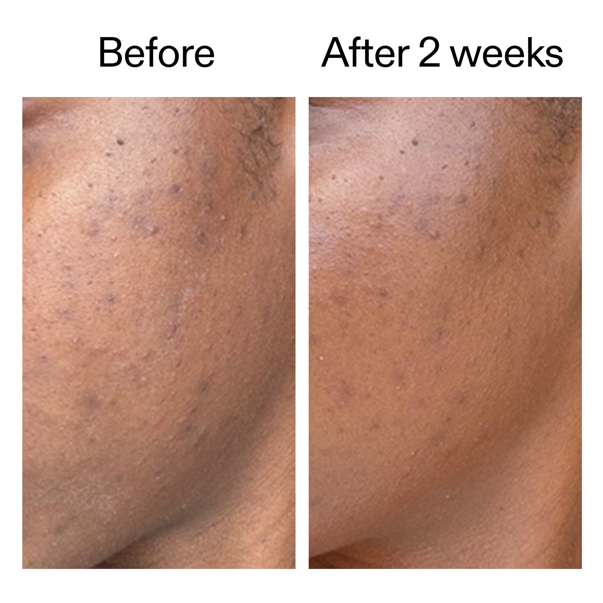360-acne-clearing-duo-t3 DIOICB_A2000x2000.jpg