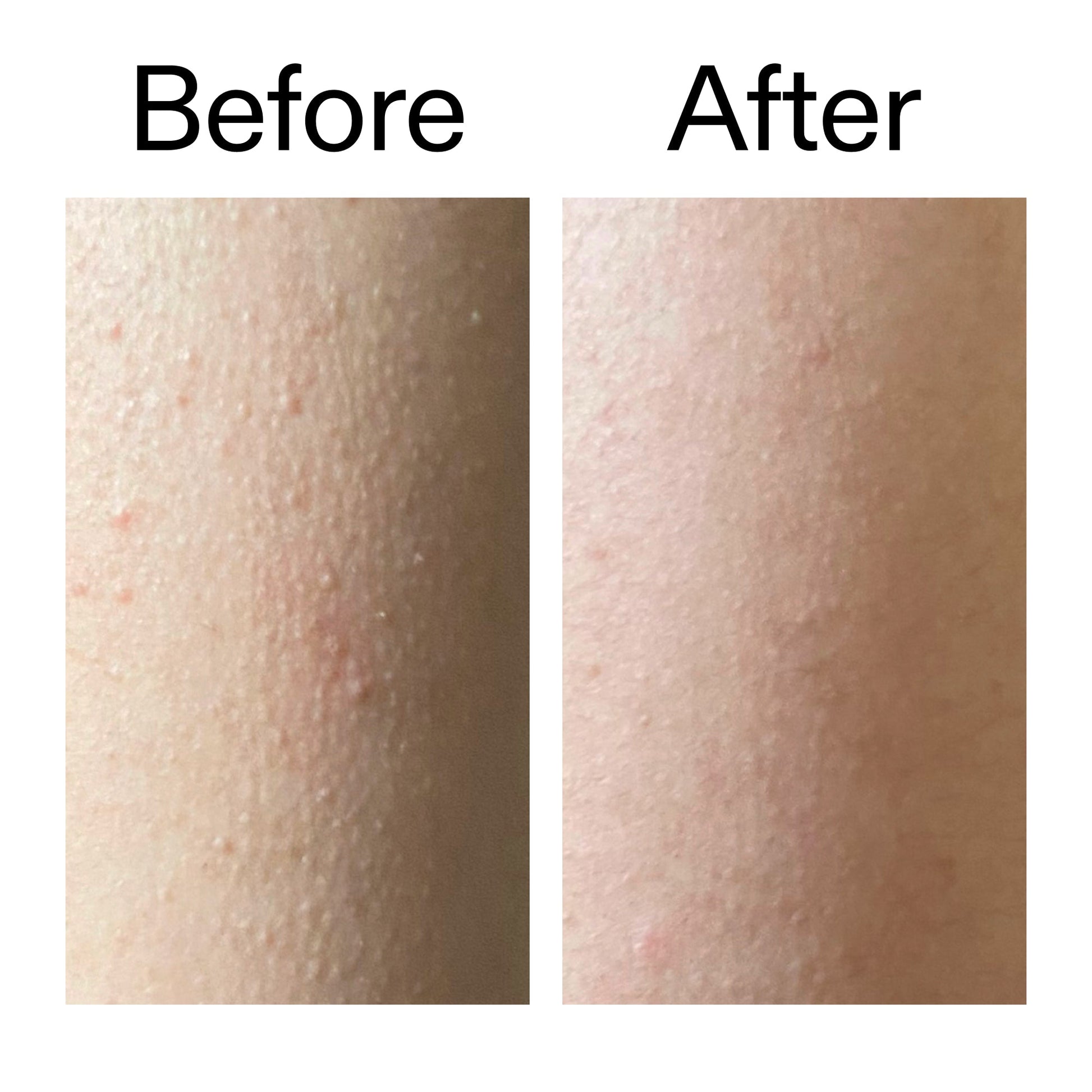 glycolic-acid-exfoliating-body-stick-a6 Glycolic_Acid_Exfoliating_Body_Stick_Before_After_V2_2000x2000_2e4ba052-94f6-4d56-82df-7bdb5b2df7ae.jpg
