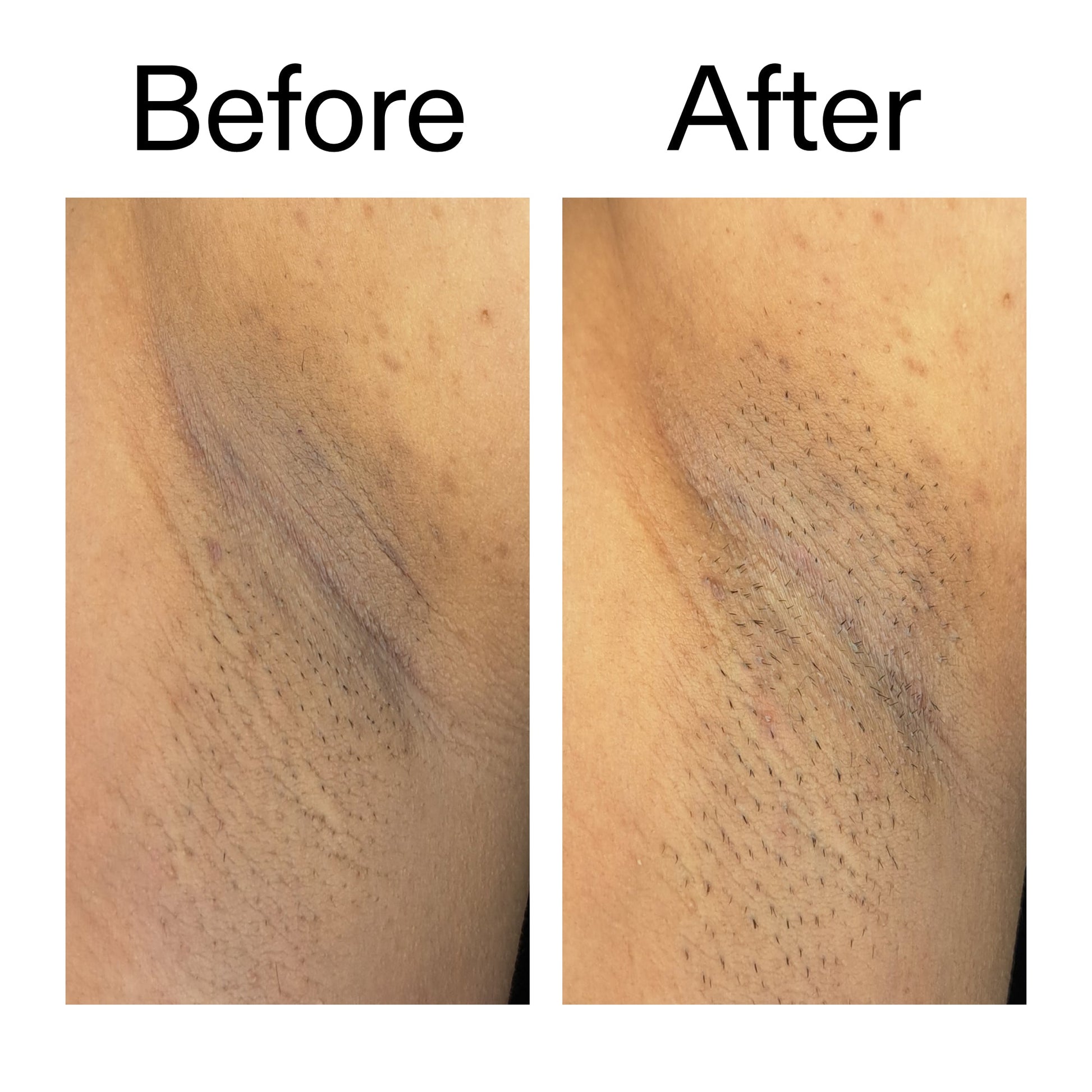 glycolic-acid-exfoliating-body-stick-a6 Glycolic_Acid_Exfoliating_Body_Stick_Before_After_V3_2000x2000_ea919cd9-1439-4a46-82a0-76200eb5bb42.jpg