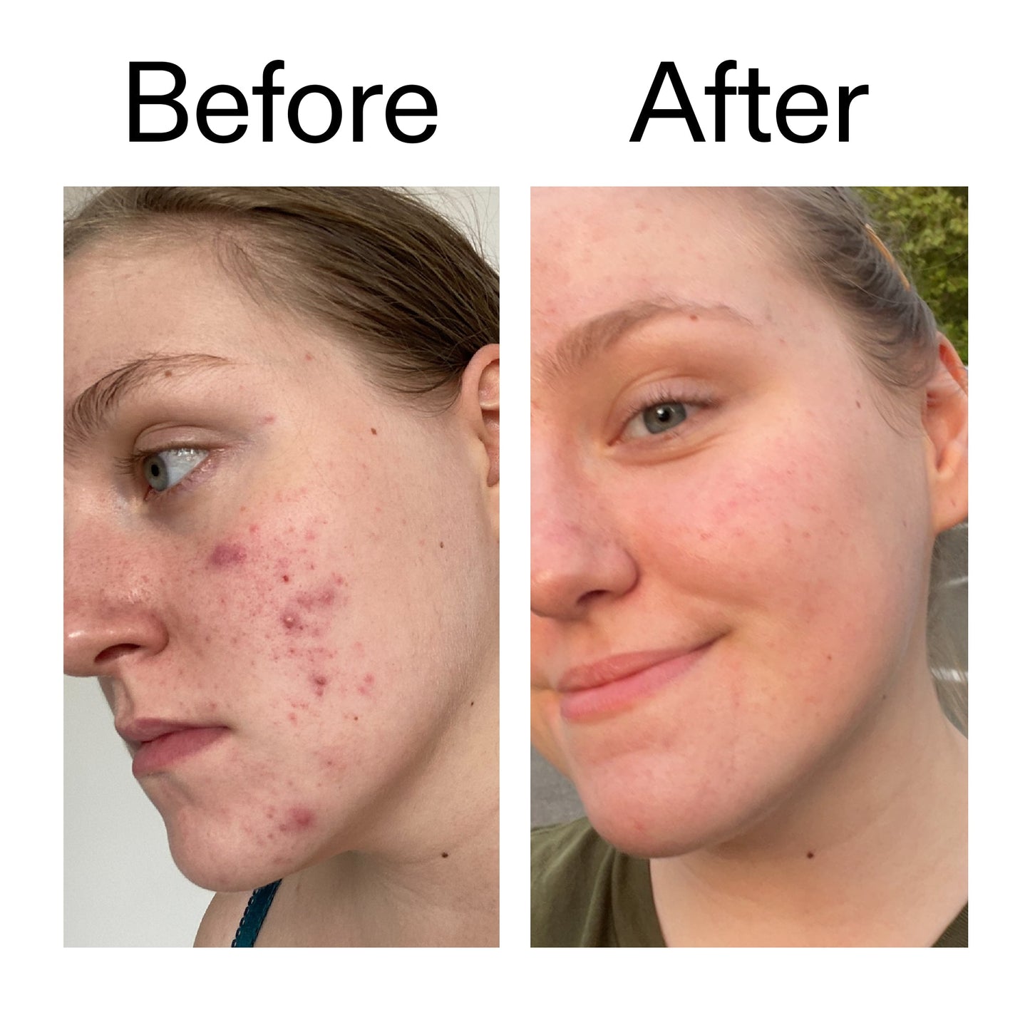 glycolic-acid-toner-f2 Glycolic_Acid_Toner_Before_After_2000x2000_49f0b9f7-e71b-4b2e-a8f8-2ea4b73247bb.jpg