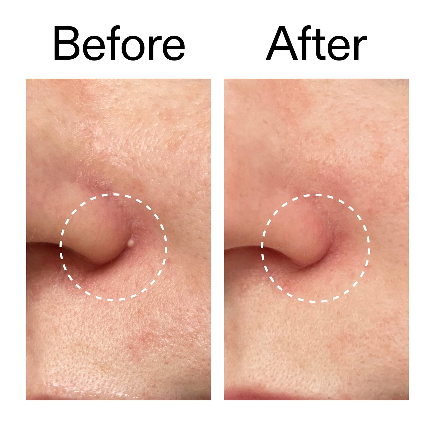 hydrocolloid-invisible-pimple-patches-pack-of-44-v1 Hydrocolloid_Invisible_Pimple_Patches_Before_After_2000x2000_b02aa37b-c78a-4682-91de-9135af5bb7df.jpg