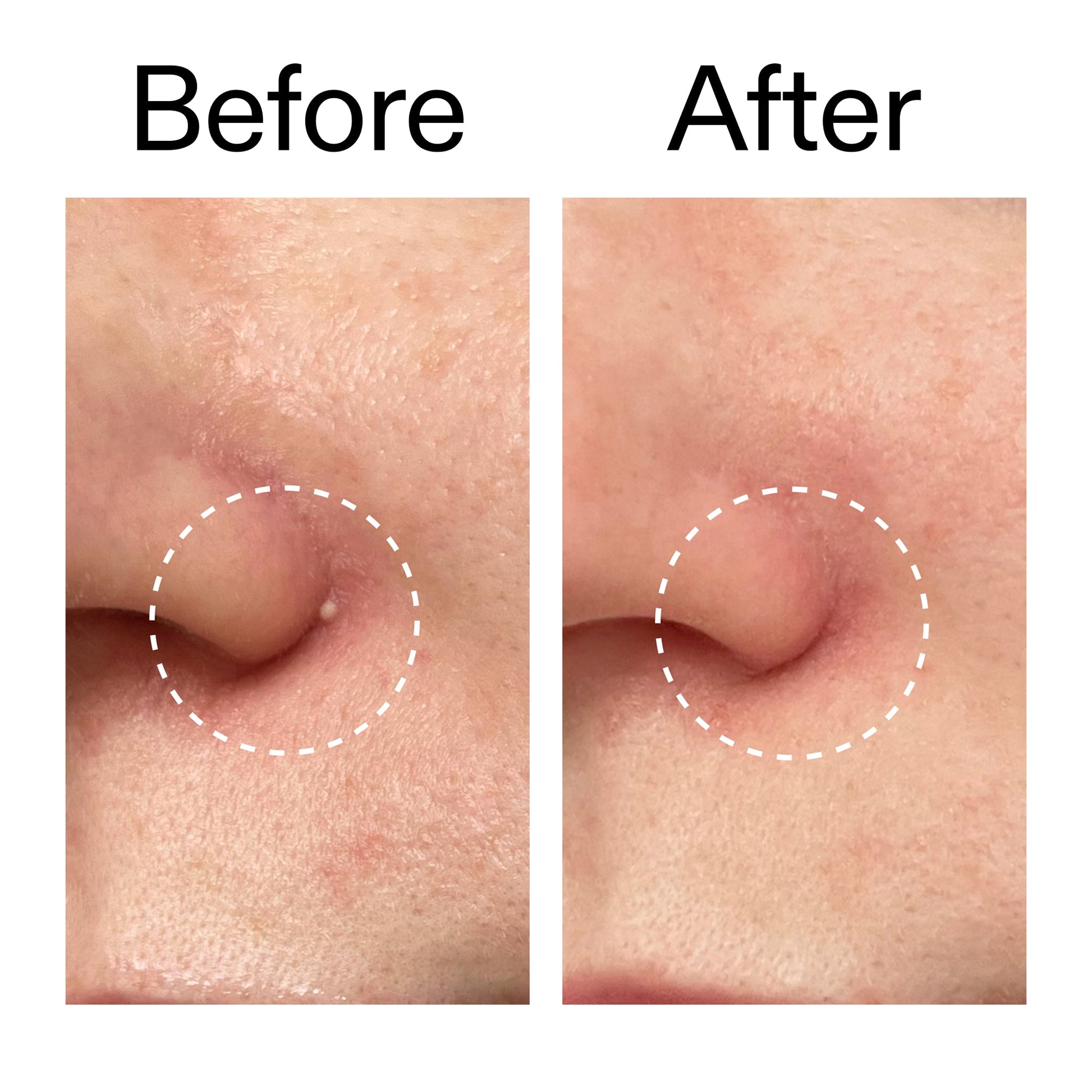 hydrocolloid-invisible-pimple-patches-pack-of-44-v1 Hydrocolloid_Invisible_Pimple_Patches_Before_After_2000x2000_b02aa37b-c78a-4682-91de-9135af5bb7df.jpg