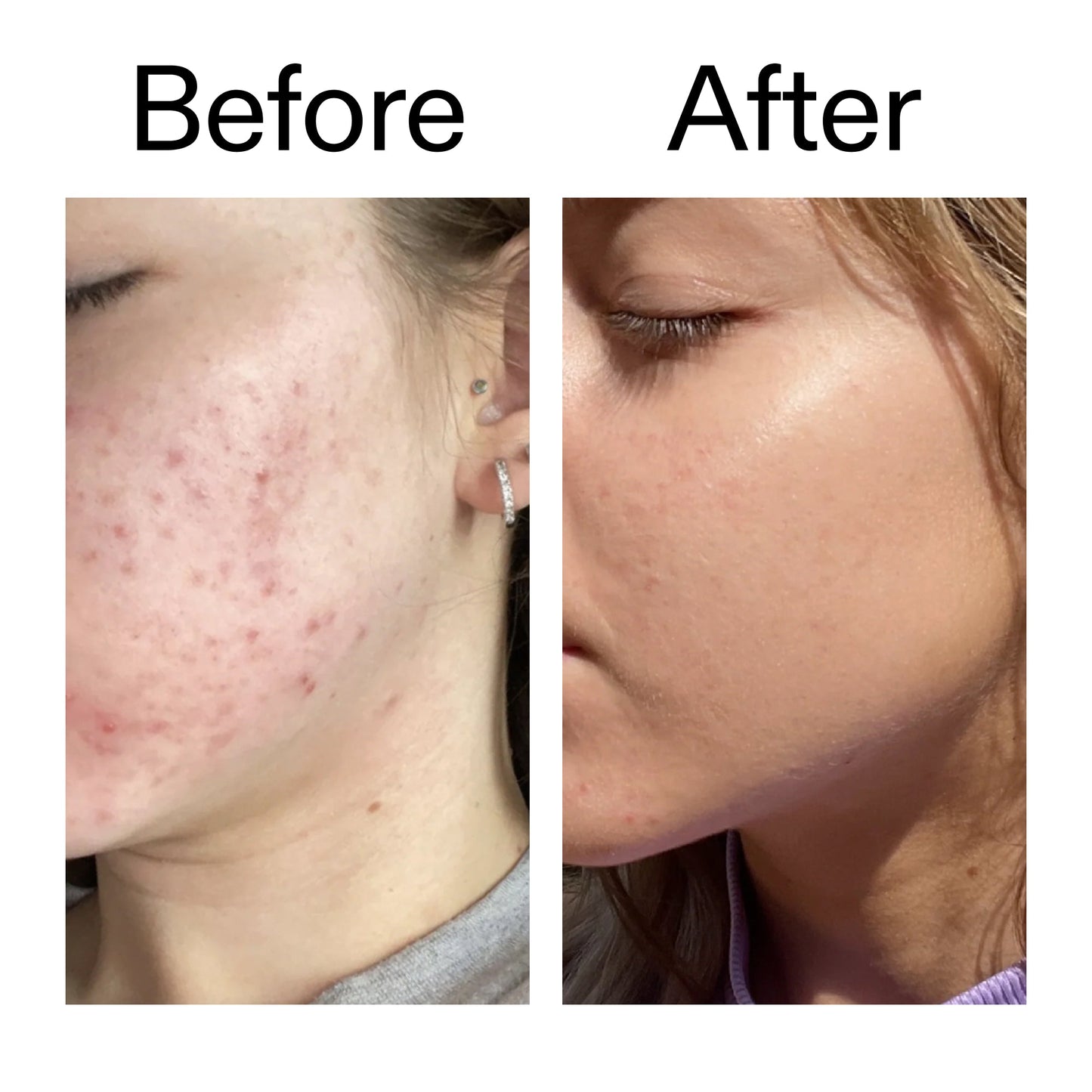 10-niacinamide-serum-duo-b8 Niacinamide_Serum_Before_After_2000x2000_bde32455-9e7d-448e-b053-bef41504f0a9.jpg