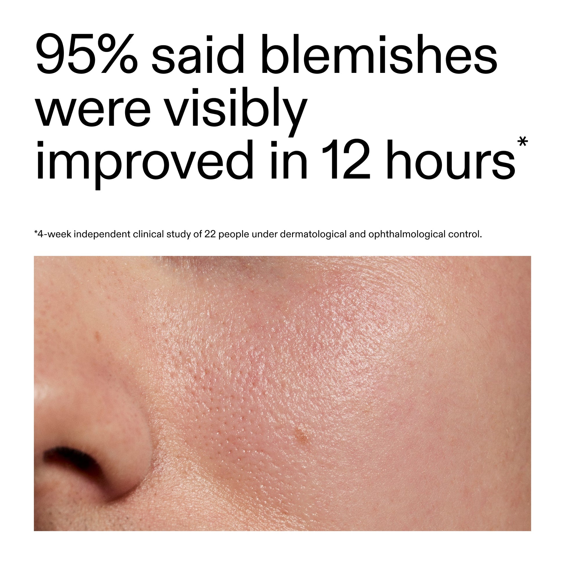 succinic-acid-acne-treatment-j6 Oat_Cleansing_Balm_Claim_2000x2000_ac6ce553-25db-41b2-a981-faae1ac4b8c0.jpg