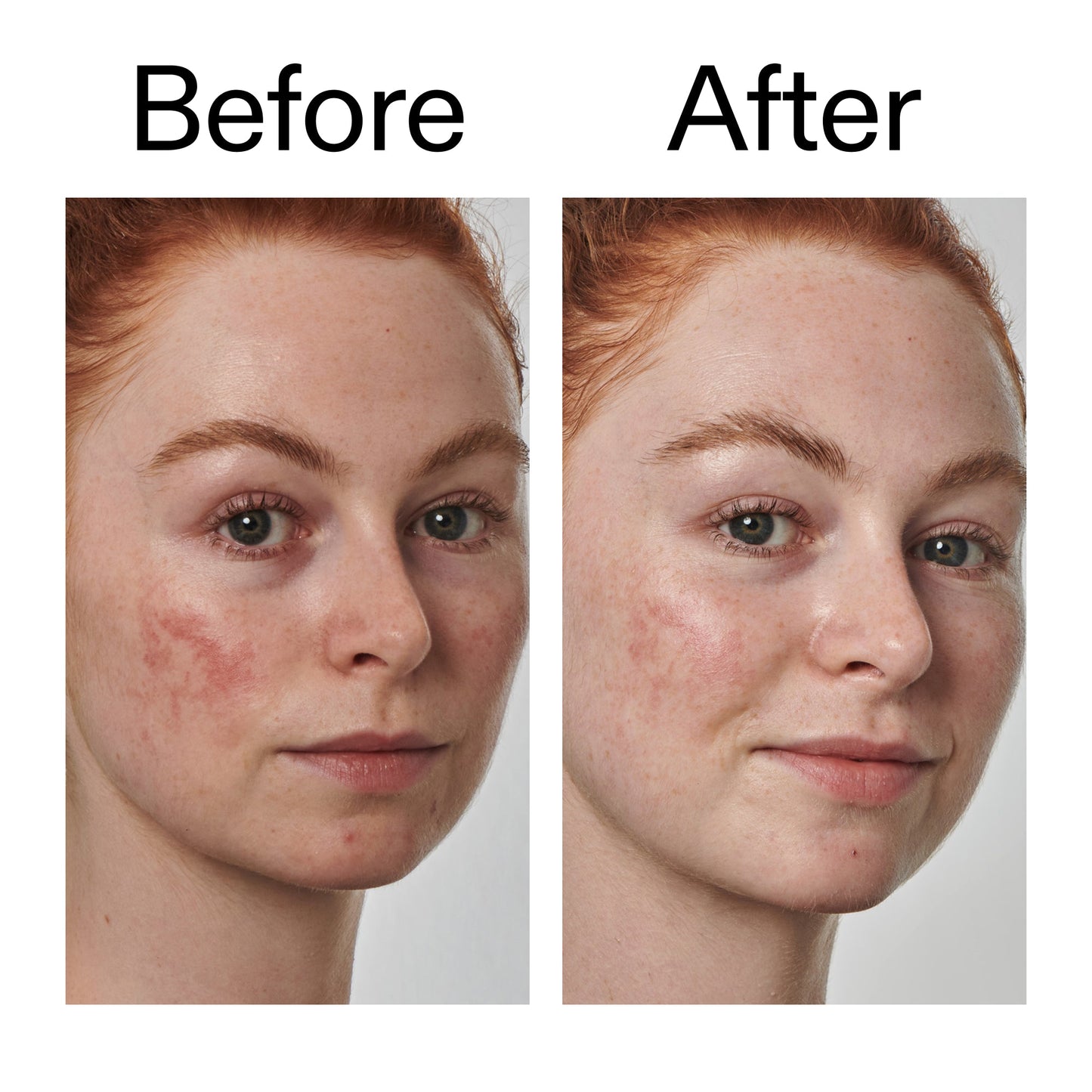 10-azelaic-acid-serum-for-redness-relief-k0 Redness_Relief_Serum_Before_After_2000x2000_3334dc9a-cce9-4e00-8aec-7ad89ca051f2.jpg