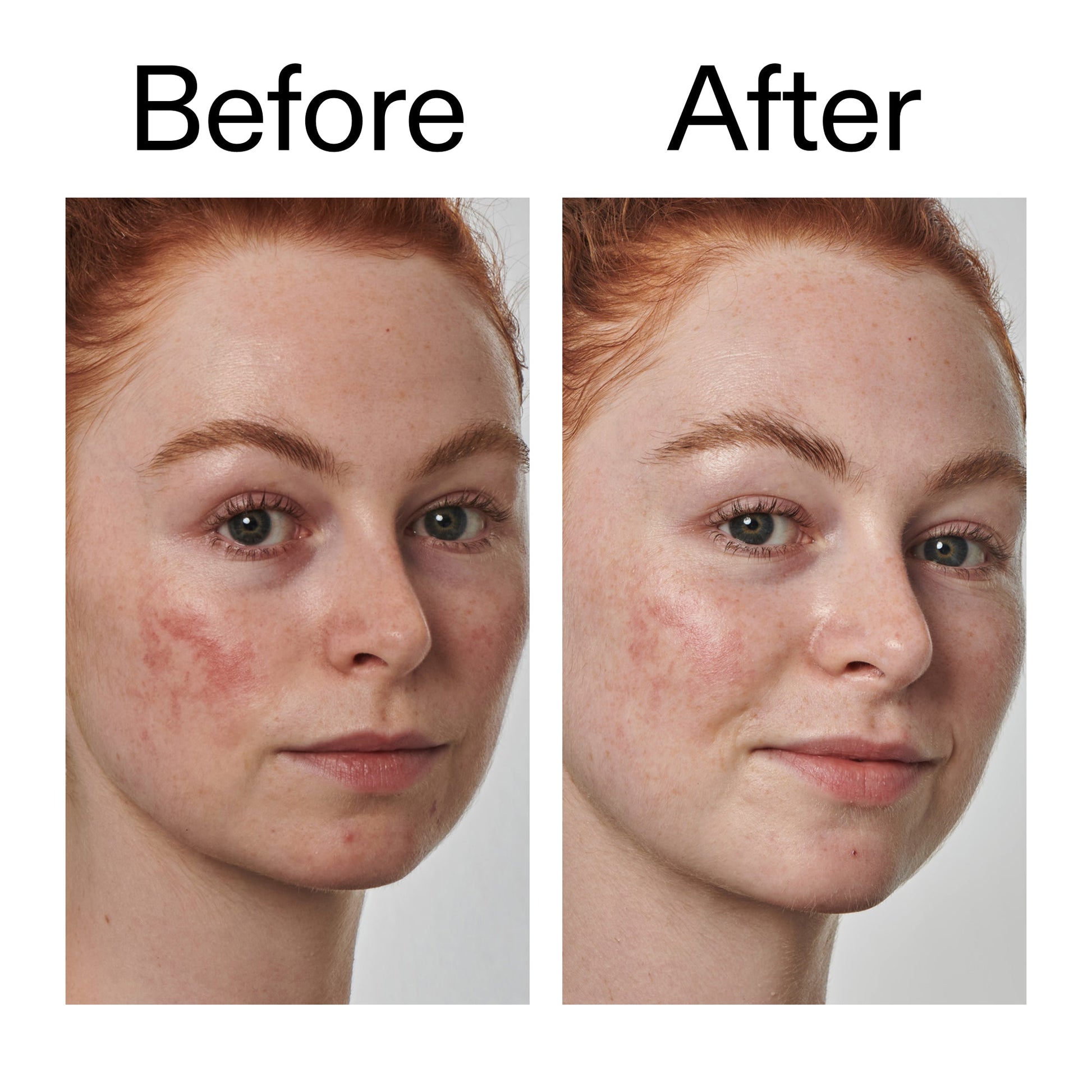 10-azelaic-acid-serum-for-redness-relief-k0 Redness_Relief_Serum_Before_After_2000x2000_3334dc9a-cce9-4e00-8aec-7ad89ca051f2.jpg
