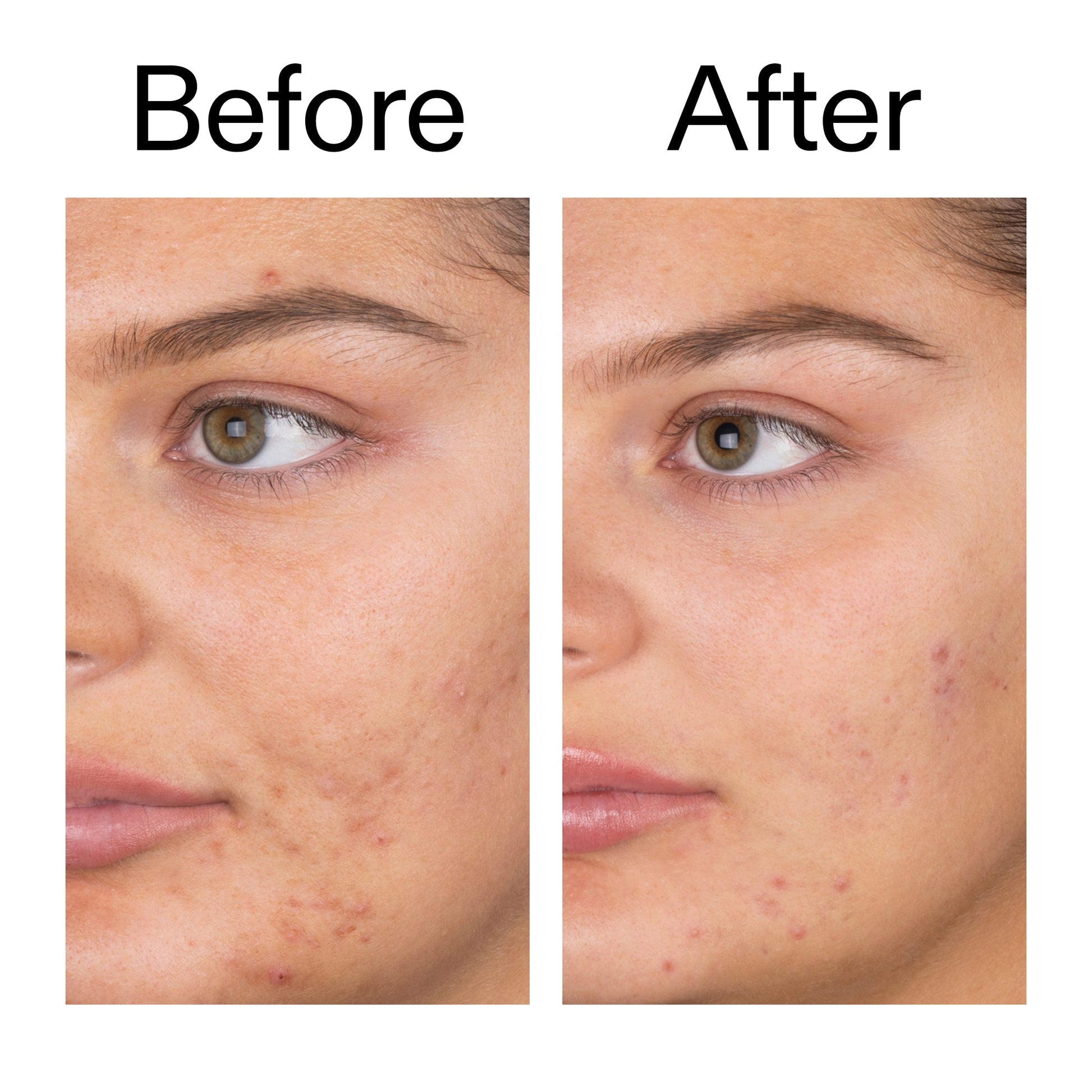 salicylic-acid-cleanser-150ml-t5 Salicylic_Acid_Cleanser_-_150ml_Before_After_2000x2000_e7230494-853f-4b07-82b1-27669104c995.jpg