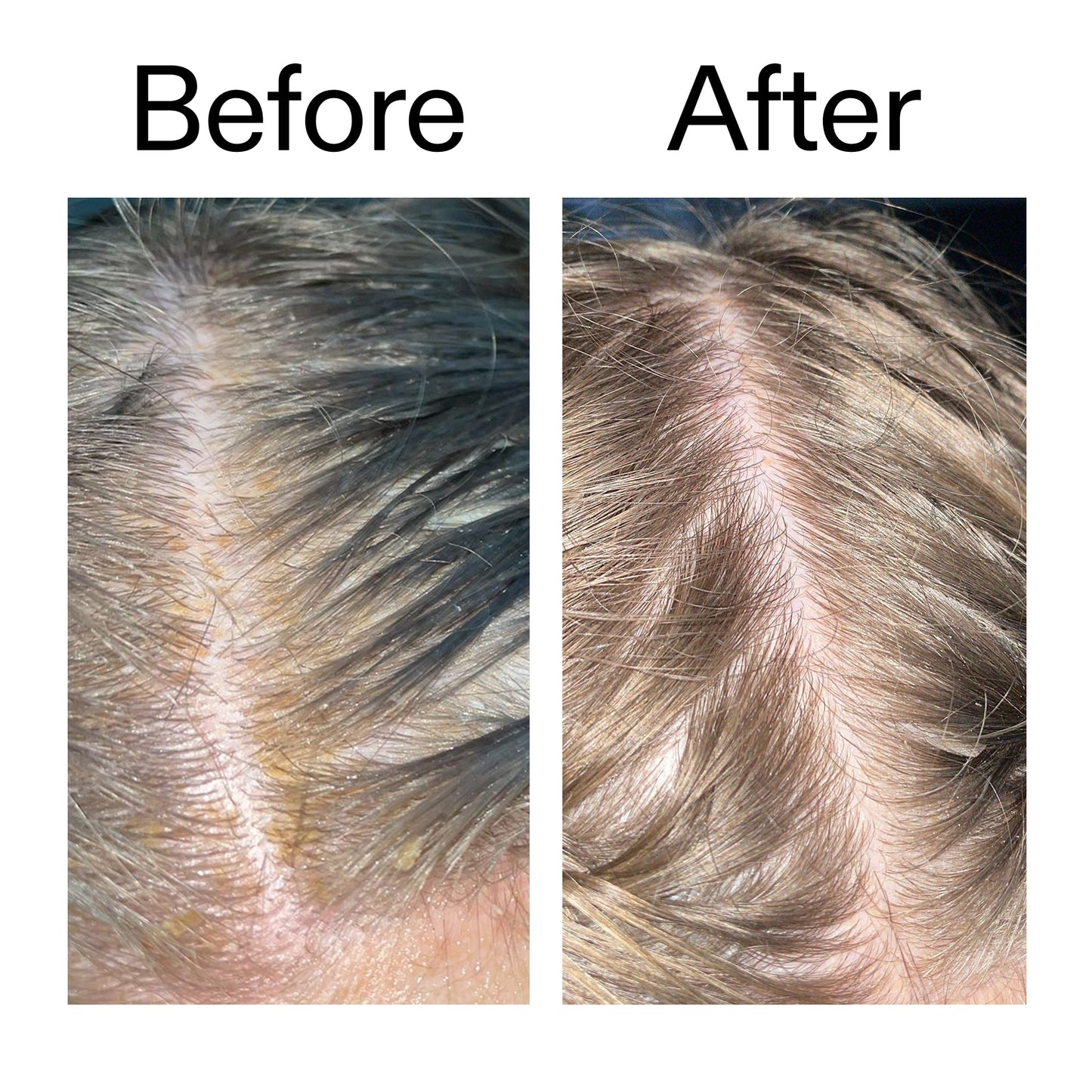 salicylic-acid-exfoliating-scalp-treatment-y3 Salicylic_Acid_Exfoliating_Scalp_Treatment_Before_After_2000x2000_e572a30f-057c-4a48-823b-1c09dc97f8d0.jpg