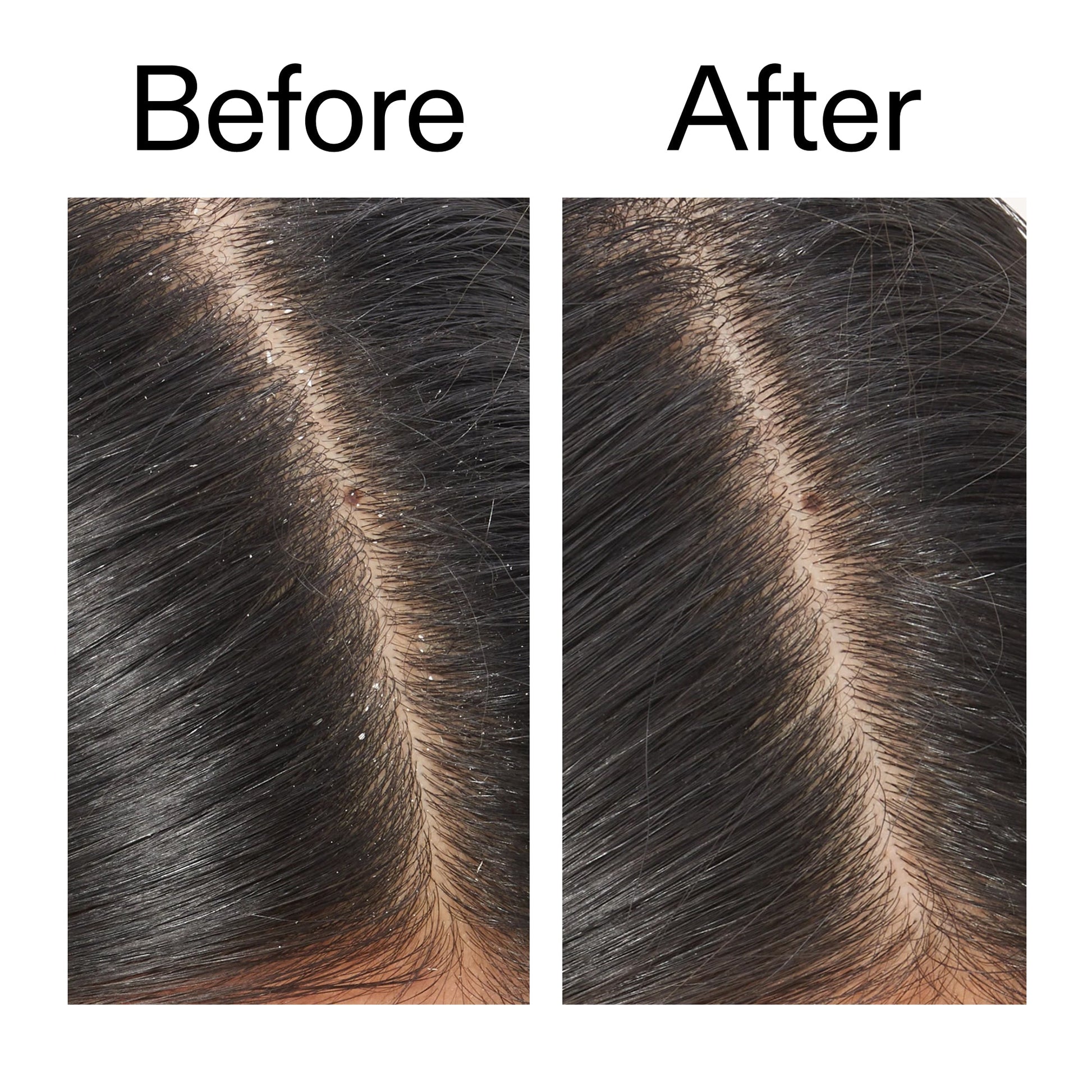 salicylic-acid-exfoliating-scalp-treatment-y3 Salicylic_Acid_Exfoliating_Scalp_Treatment_Before_After_V2_2000x2000_02bd61ad-42bf-490b-b3e3-7e04b2e8a673.jpg
