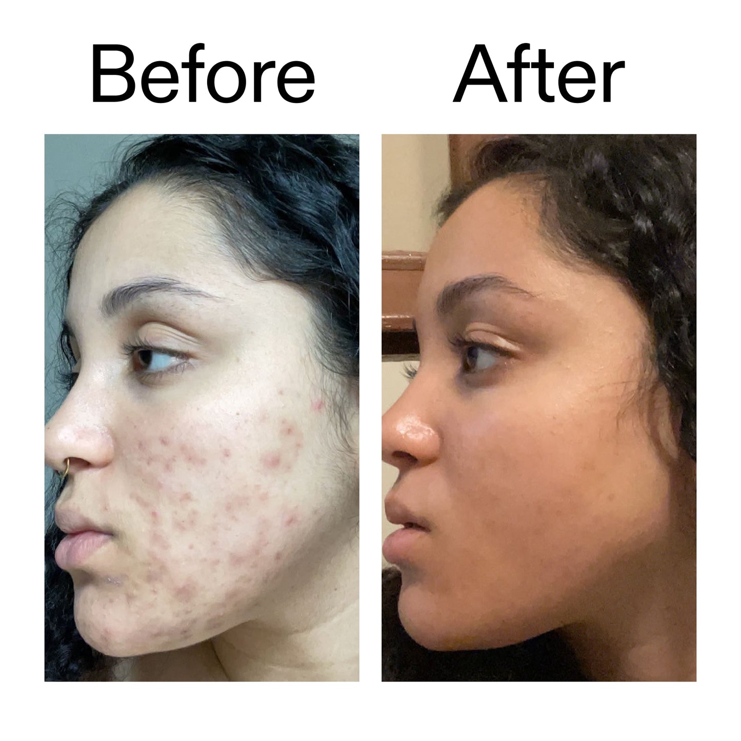 tranexamic-acid-serum-z4 Tranexamic_Acid_Serum_Before_After_2000x2000_98ebc8be-77b0-4843-8a22-90790ebe918b.jpg